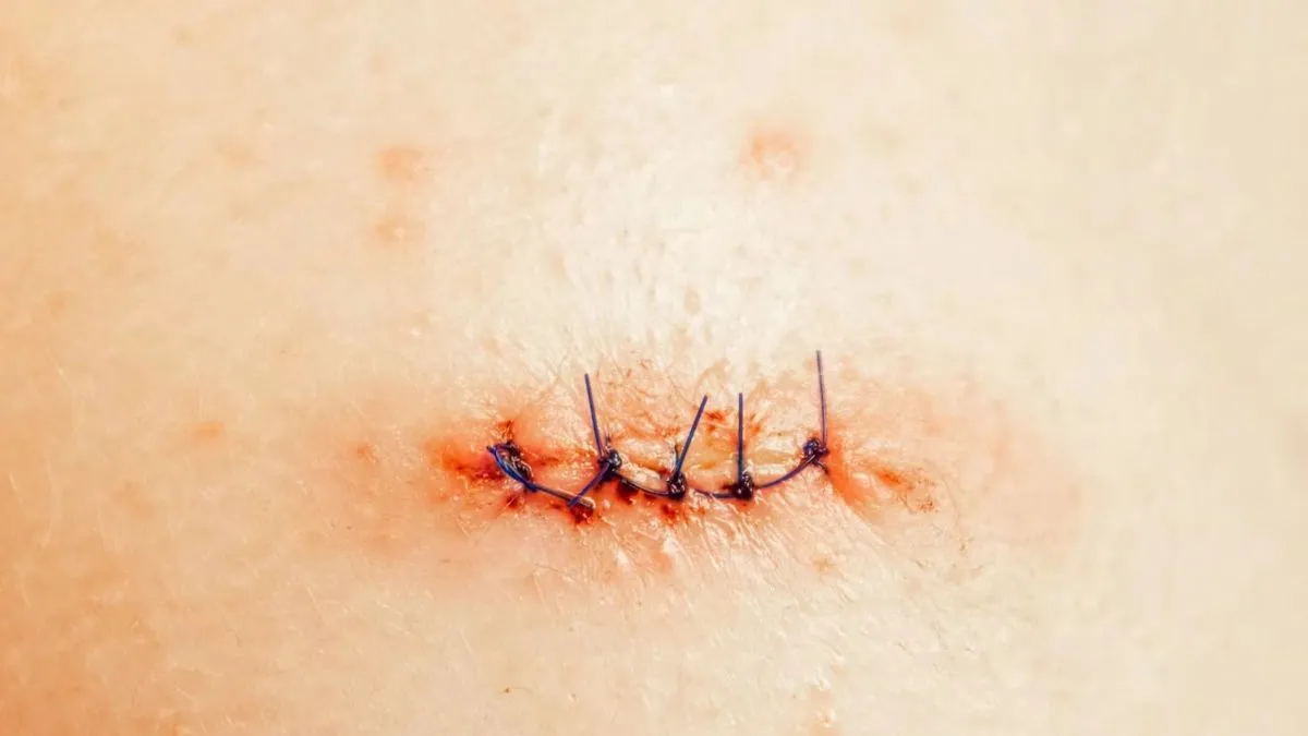 stitches 