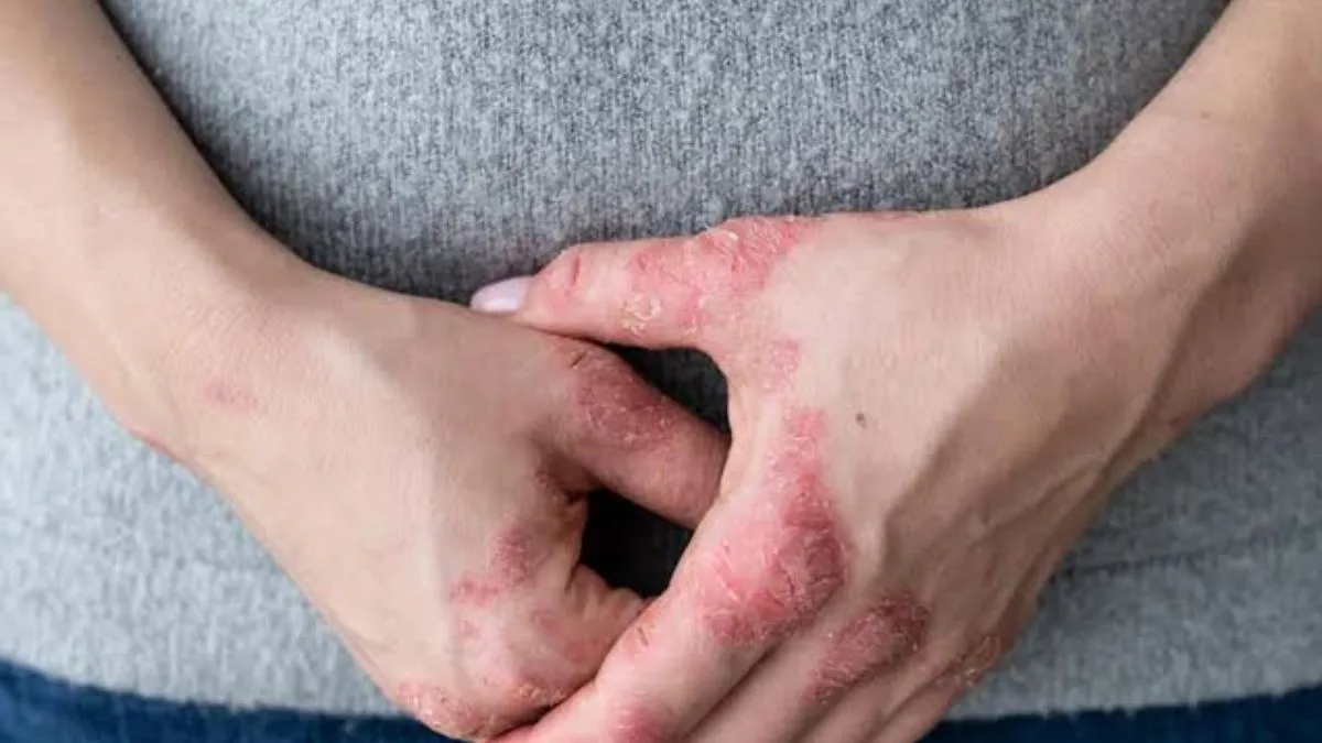 electric burn 
