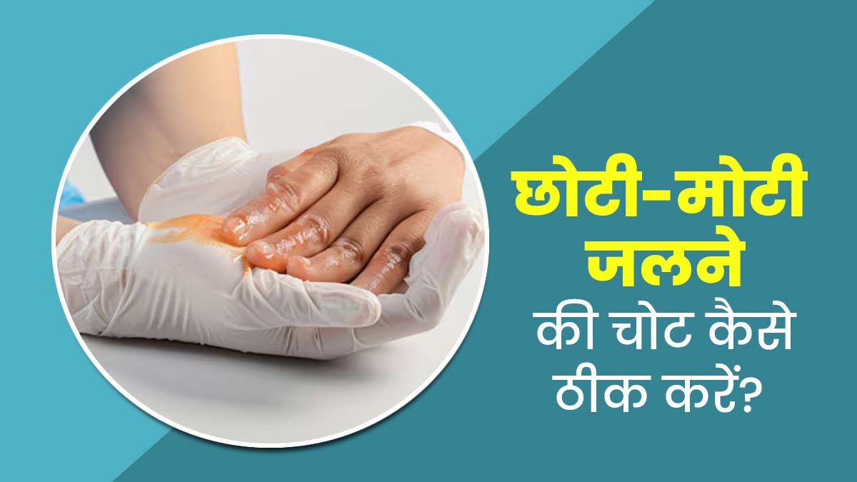जल जाने पर छोटे-मोटे घाव या छाले को ठीक कैसे करें? डॉक्टर से जानें 6 स्टेप्स