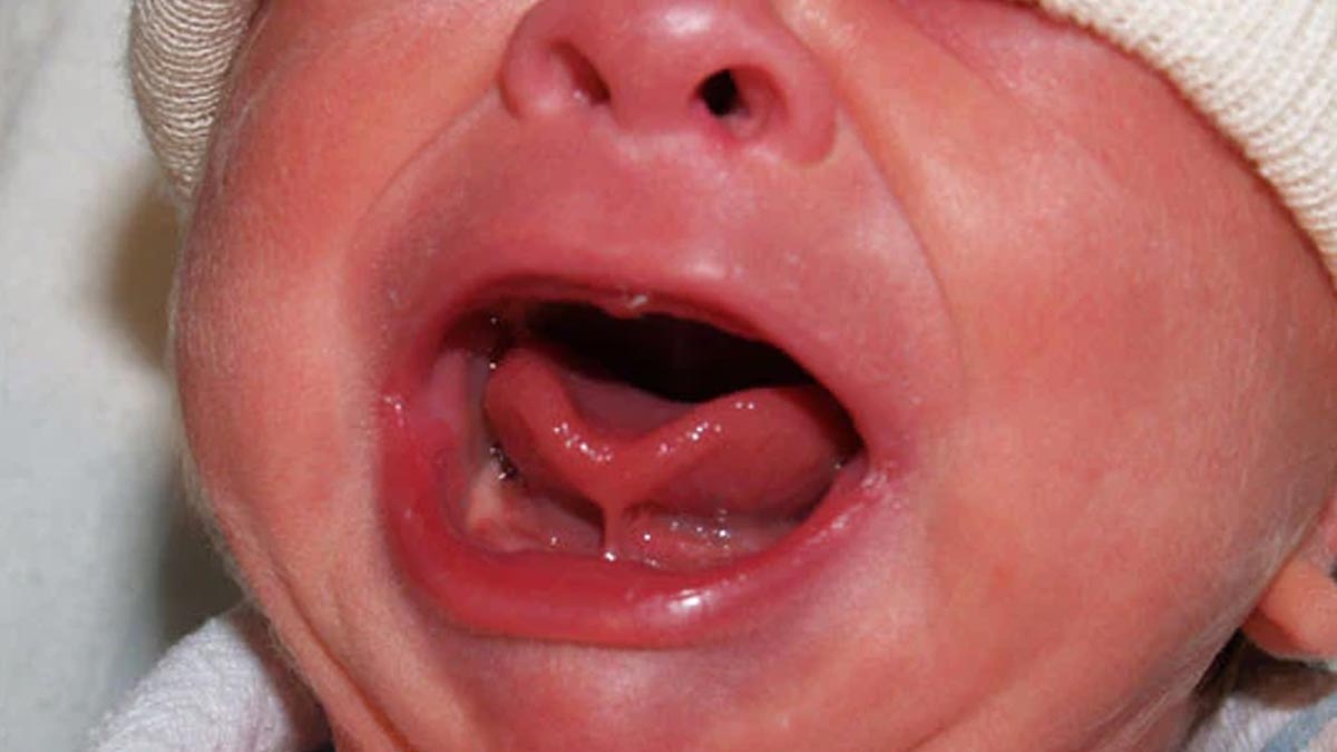 Tongue-Tie-issue-insie