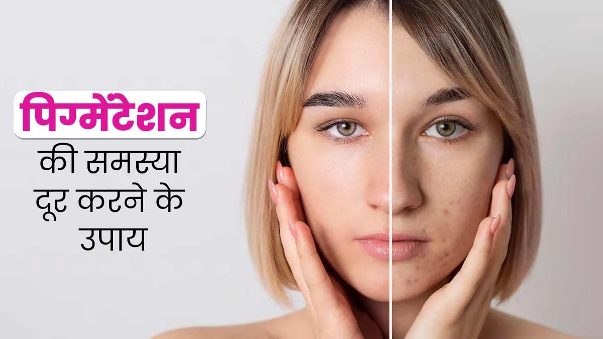 पिग्मेंटेशन ने खराब कर दी चेहरे की खूबसूरती? इन 4 उपायों से मिलेगा जल्द छुटकारा