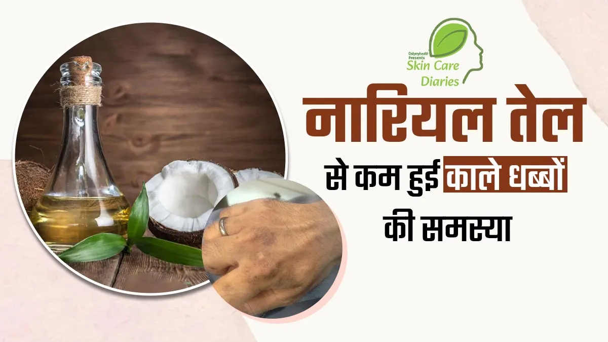 विकास के चेहरे और हाथ पर हो गए थे पपड़ीदार काले धब्बे, वर्जिन कोकोनट ऑयल लगाने से कुछ ही हफ्तों में मिला आराम
