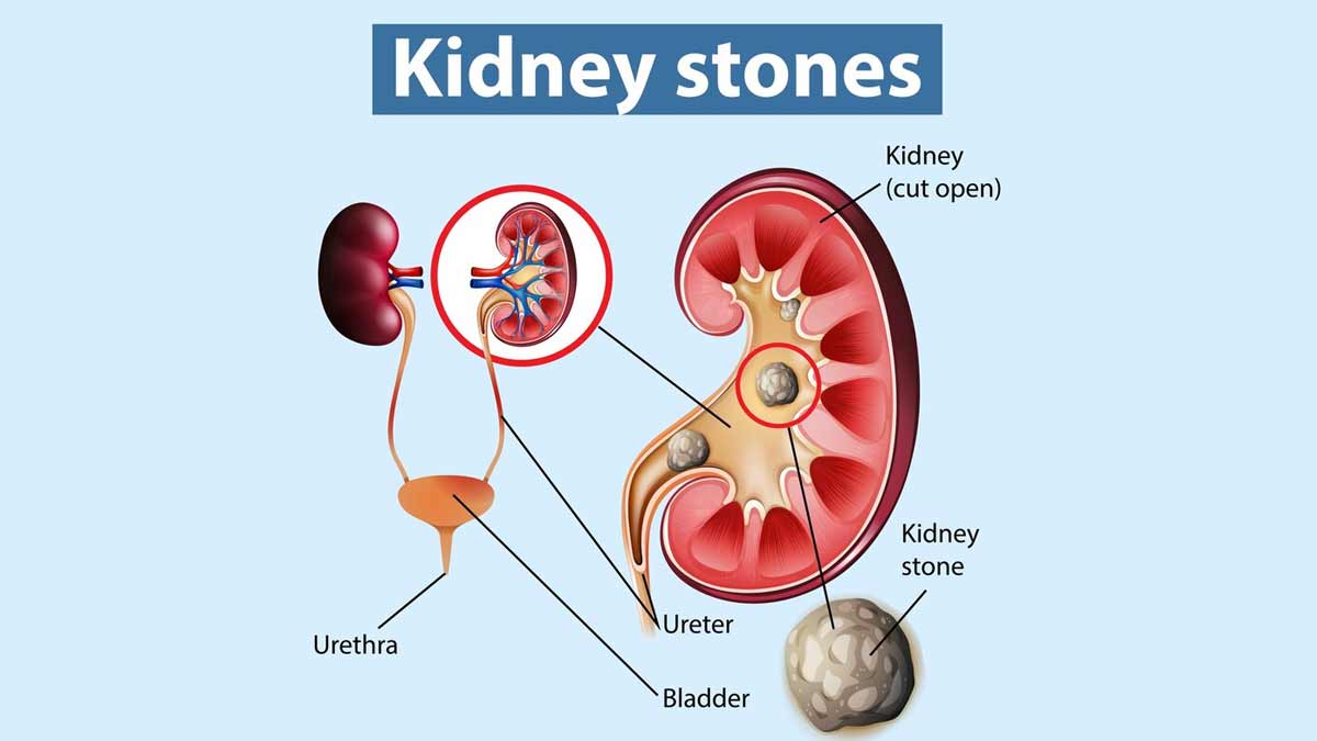 kidney stone causes and types in hindi