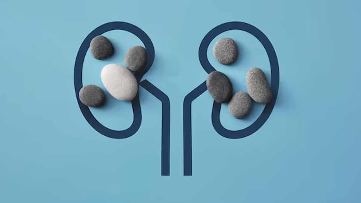 kidney-stone-risk
