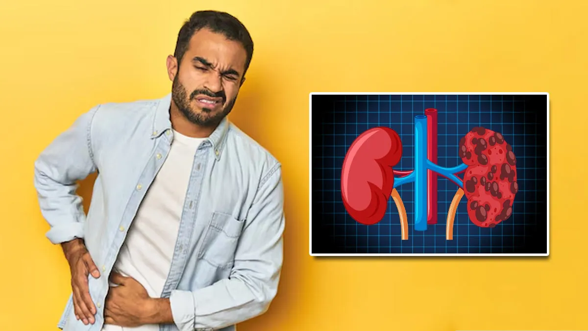 किडनी की पथरी हो गई है तो अपनाएं ये 4 टिप्स, डैमेज होने से होगा बचाव