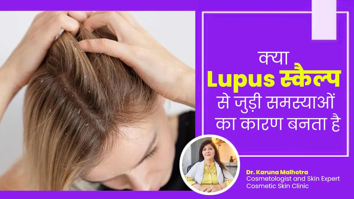 क्या ल्यूपस स्कैल्प से जुड़ी समस्याओं का कारण बन सकता है? जानें एक्सपर्ट से
