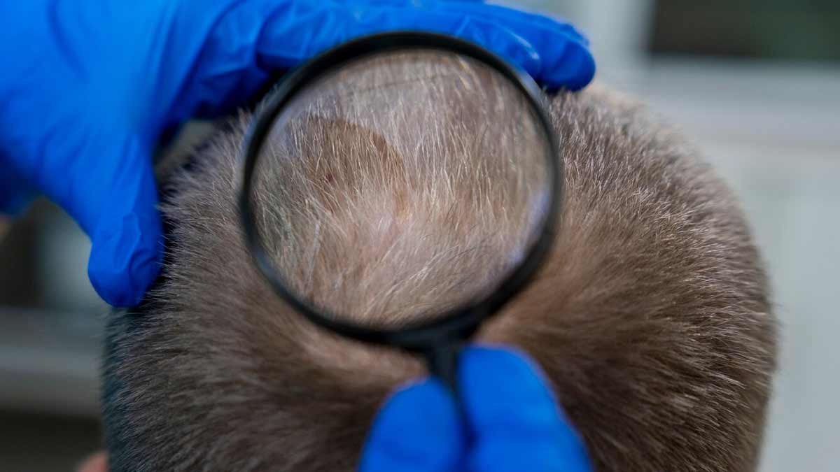 Does-Lupus-cause-scalp-related-issues-01