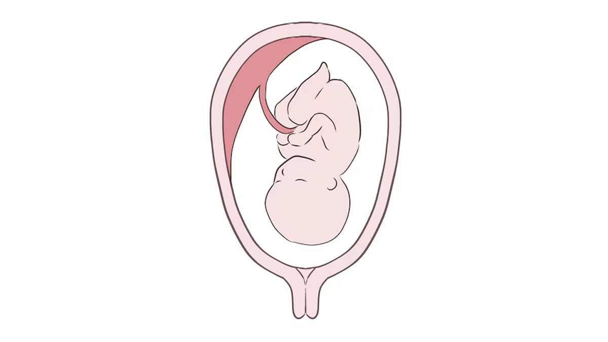 is-normal-delivery-possible-in-placenta-previa-01