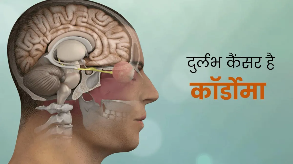 खोपड़ी या रीढ़ की हड्डी में होने वाला दुर्लभ कैंसर है कॉर्डोमा, डॉक्‍टर से जानें इसके लक्षण, कारण और इलाज