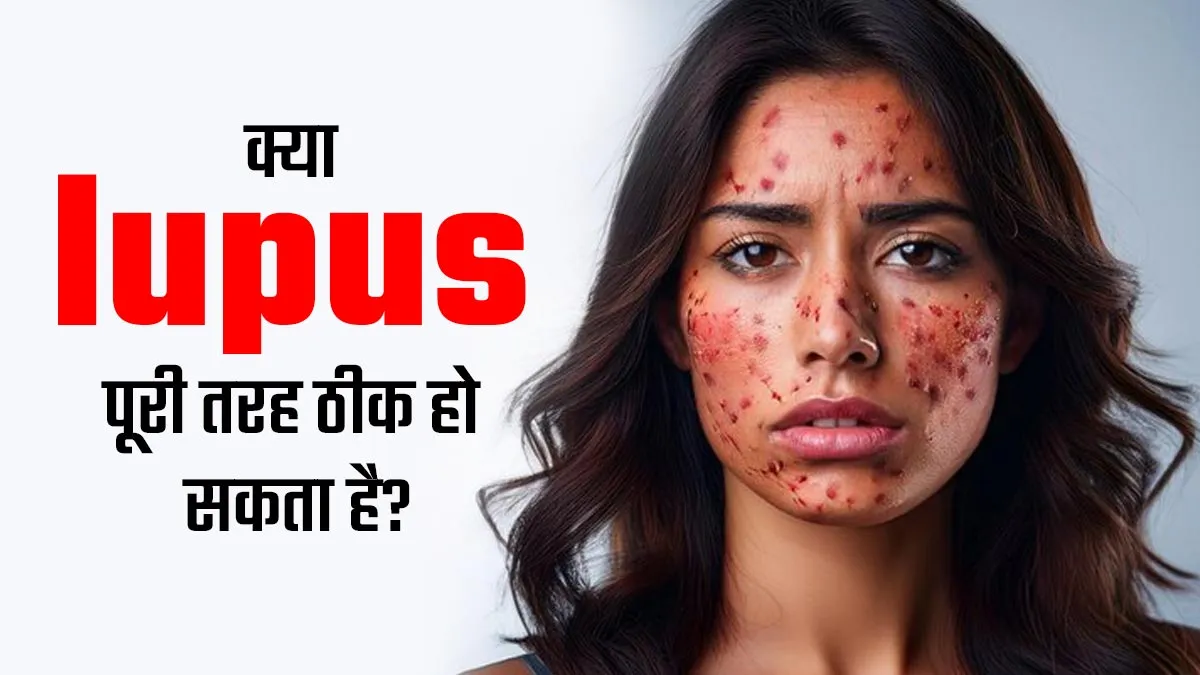 क्या ऑटो इम्यून बीमारी ल्यूपस का इलाज संभव है? डॉक्टर से जानें