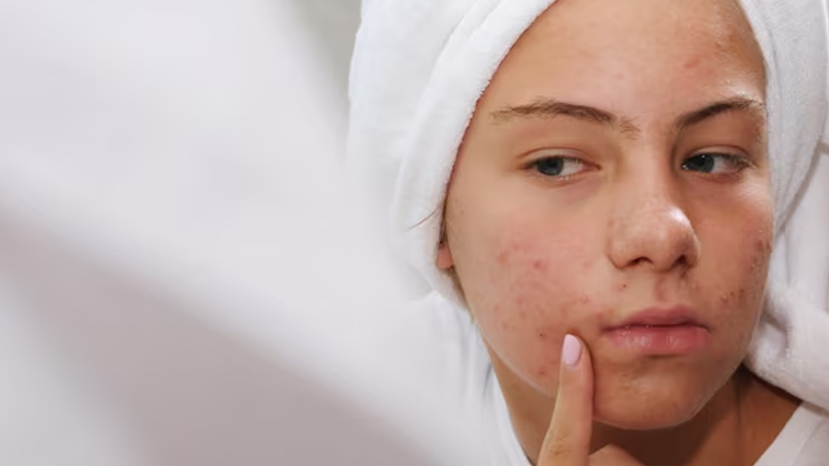 does-ivf-treatment-causes-acne-in
