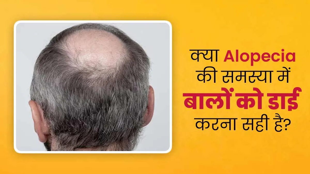 क्या एलोपेसिया की समस्या में बालों को डाई करना सुरक्षित होता है? मानें एक्सपर्ट की राय