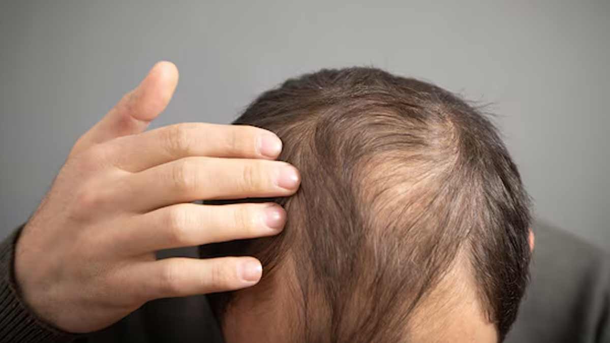 is-alopecia-curable-02