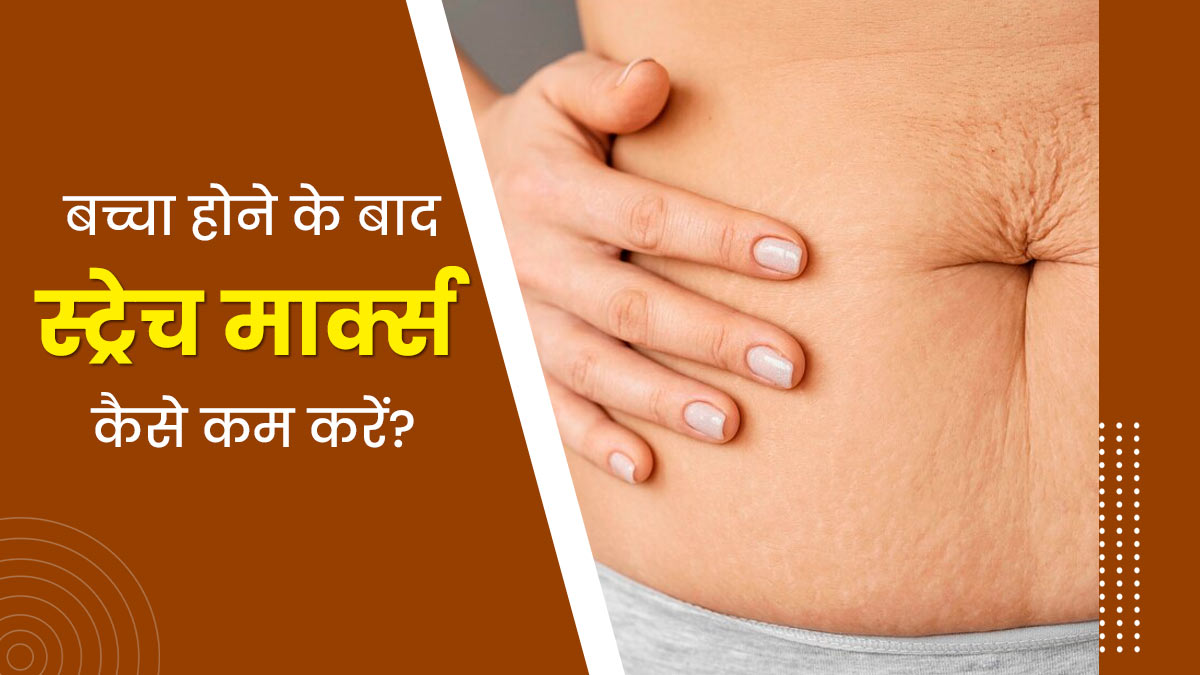 डिलीवरी के बाद पेट पर पड़े स्ट्रेच मार्क्स के निशान कैसे कम करें? जानें डॉक्टर से