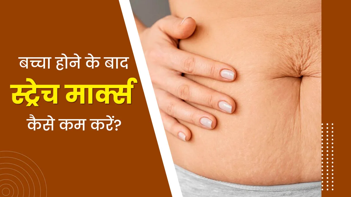 डिलीवरी के बाद पेट पर पड़े स्ट्रेच मार्क्स के निशान कैसे कम करें? जानें डॉक्टर से