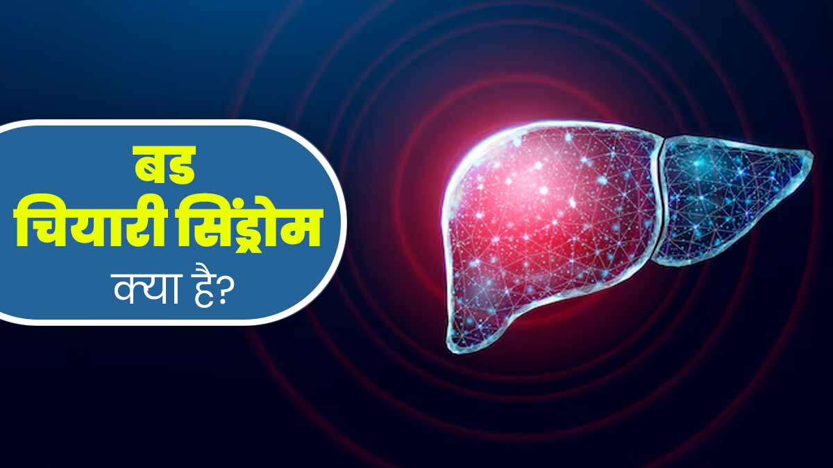ल‍िवर की नसों में ब्‍लॉकेज का कारण हो सकता है बड चियारी सिंड्रोम, डॉक्‍टर से जानें इस बीमारी के बारे में