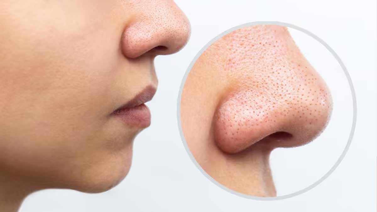 Salicylic Acid for skin  How-To-Use-Salicylic-Acid-To-Remove-Blackheads-m