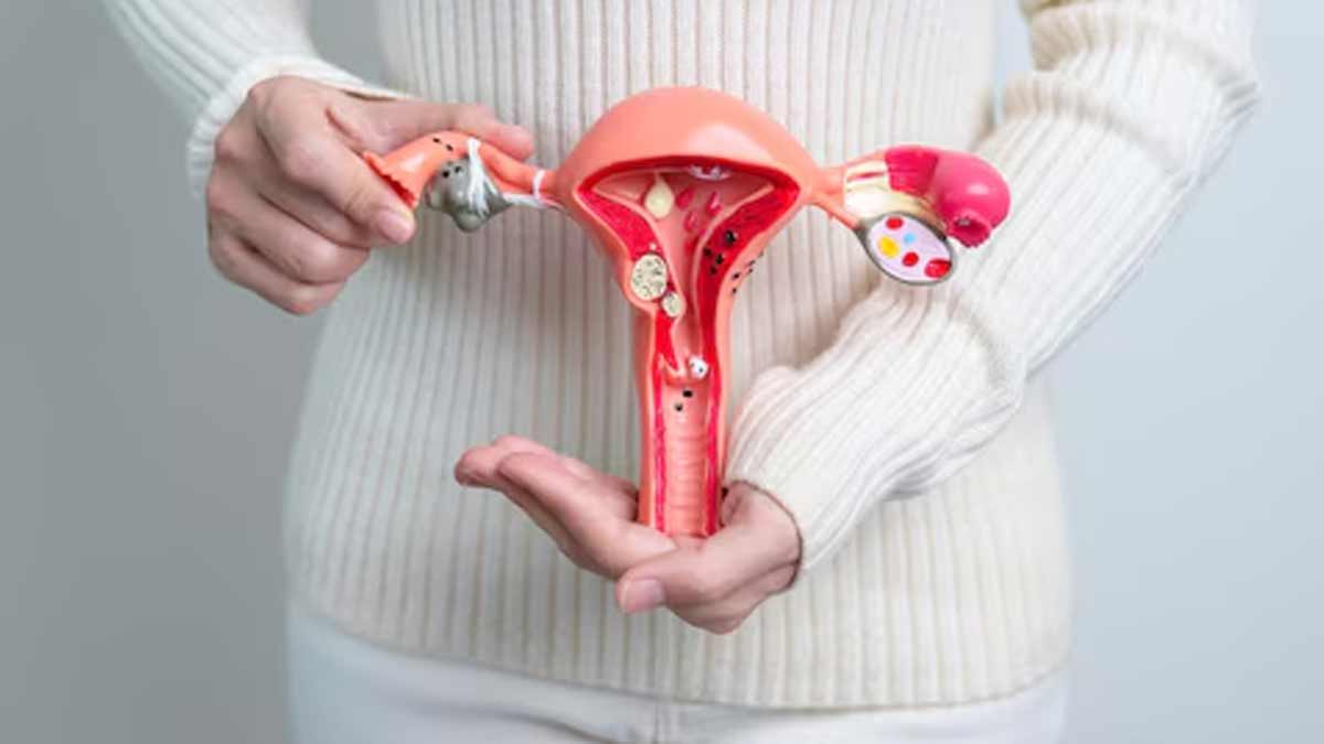 PCOS Management