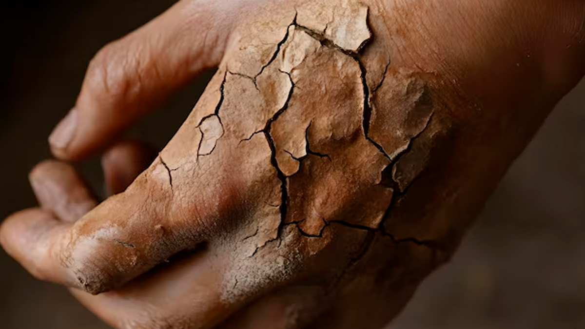 cracked-hands-in-winter