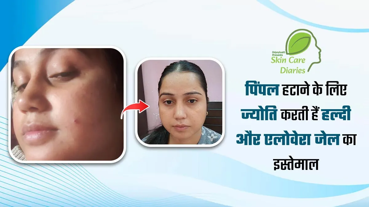 पीरियड्स के दौरान स्किन पर पिंपल्स होने पर इस तरह हल्दी और एलोवेरा लगाती हैं ज्योति, दाग भी हो जाते हैं दूर