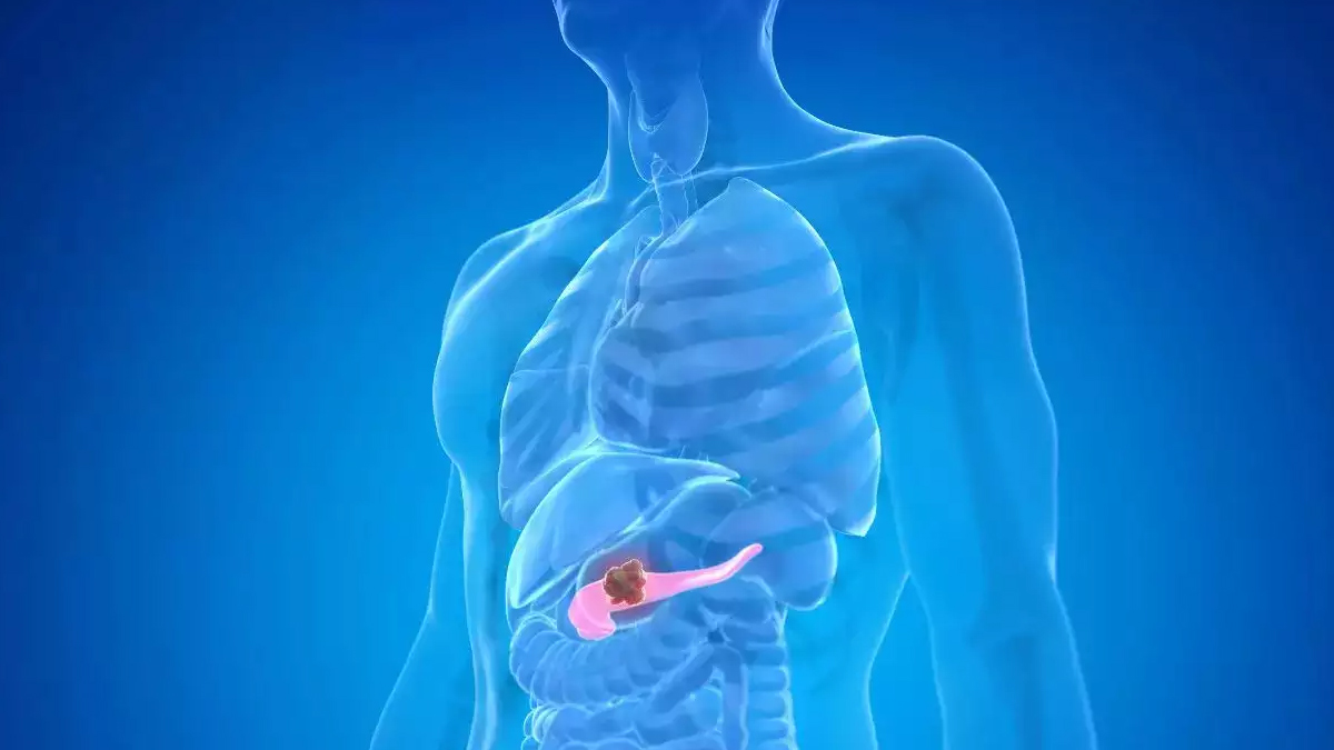 pancreaticcancer-inside