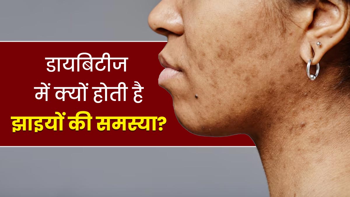 डायबिटीज के कारण हो सकती हैं चेहरे पर झाइयां? एक्सपर्ट से समझें दोनों का कनेक्शन