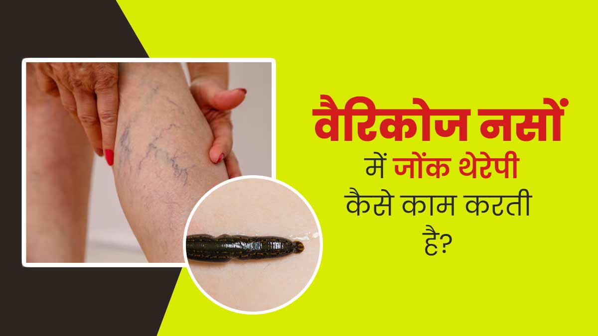 वैरिकोज वेन्स के इलाज में लीच थेरेपी (जोंक) कैसे काम करती है? डॉक्टर से जानें