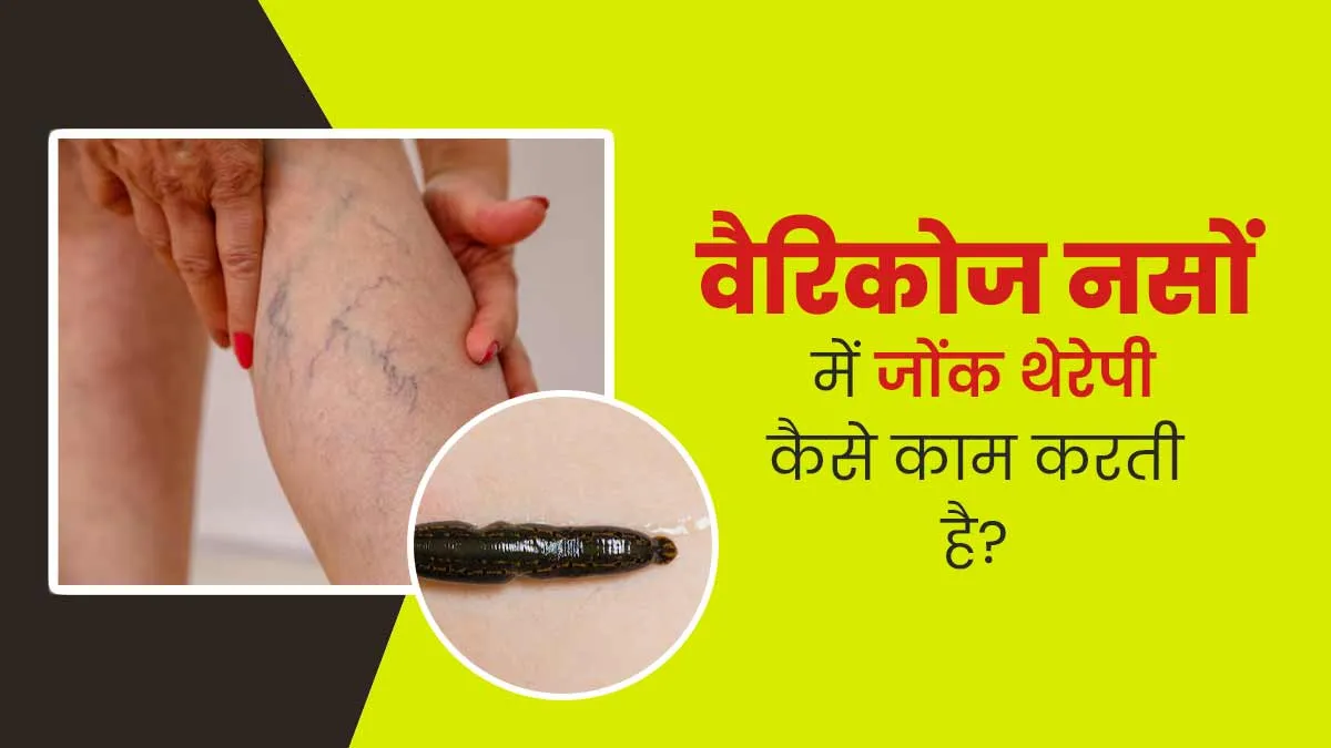 वैरिकोज वेन्स के इलाज में लीच थेरेपी (जोंक) कैसे काम करती है? डॉक्टर से जानें