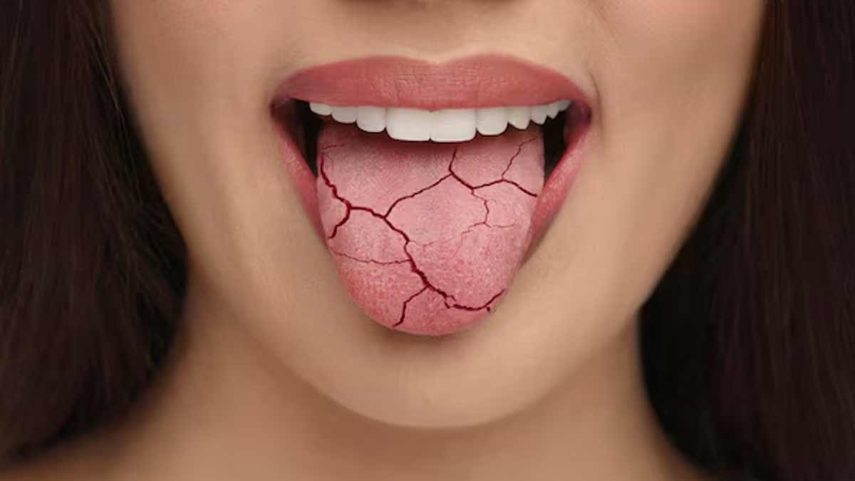 सर्दि‍यों में सूख जाता है मुंह? एक्‍सपर्ट से जानें इसका कारण और राहत के लिए 5 घरेलू उपाय 
