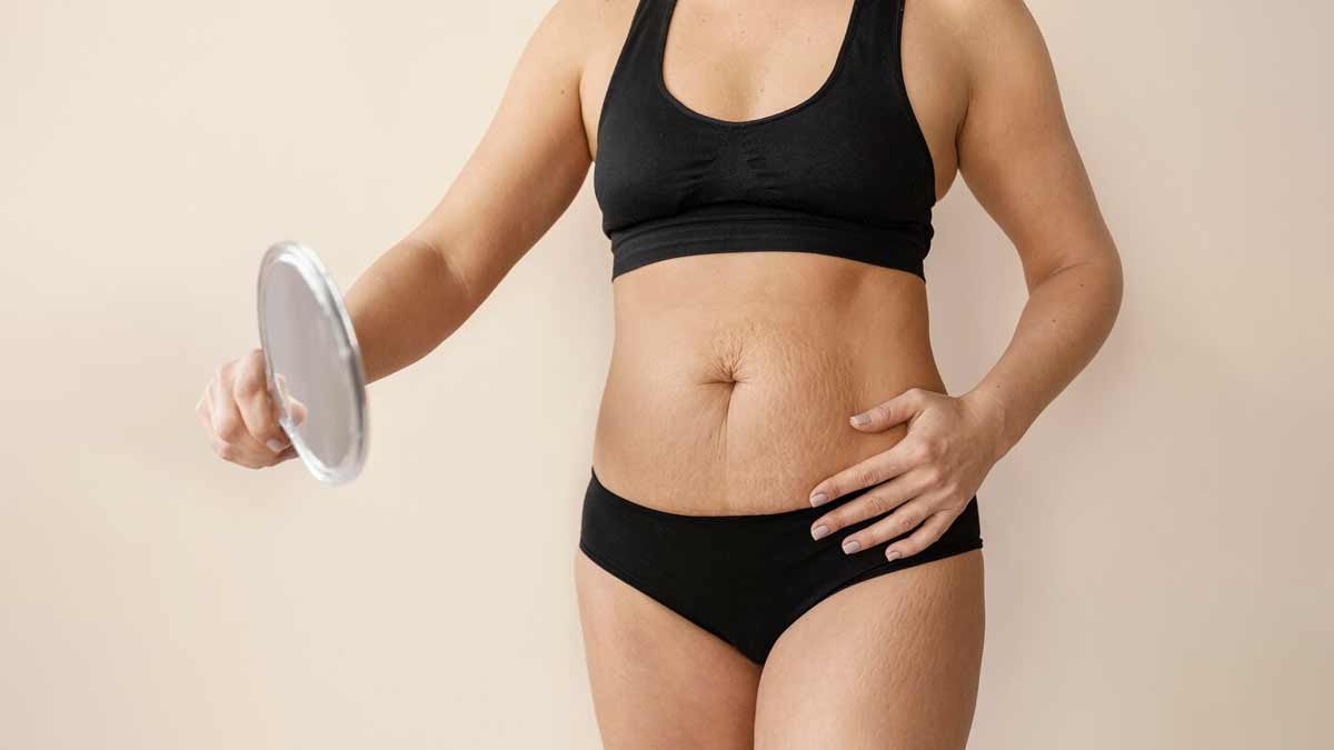 स्ट्रेच मार्क्स की समस्या क्यों होती है? जानें एक्सपर्ट से