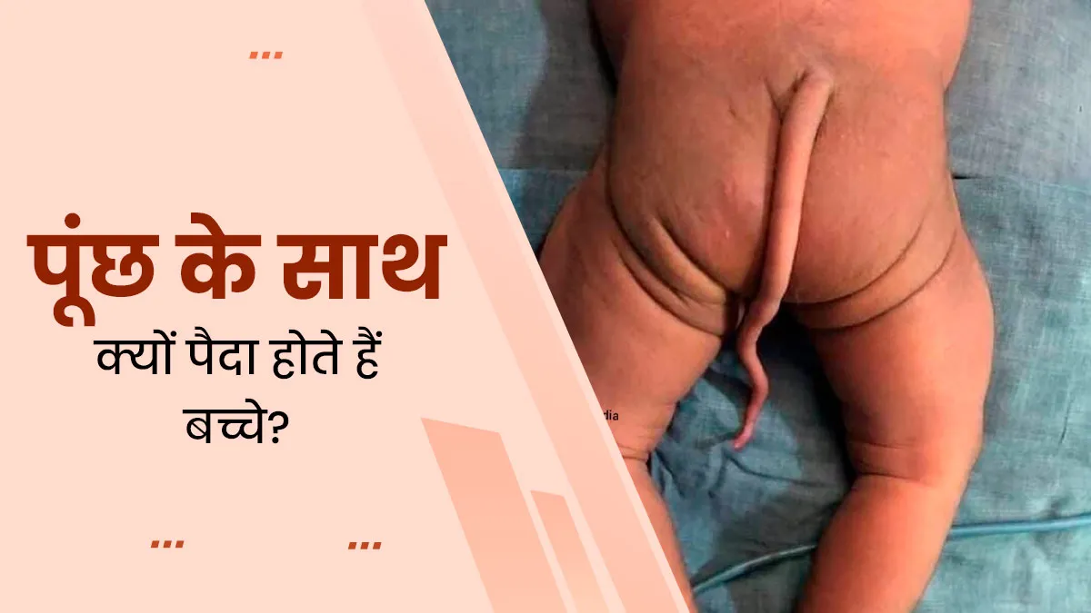कुछ बच्चे पूंछ के साथ क्यों पैदा होते हैं? जानें इसका कारण और इलाज