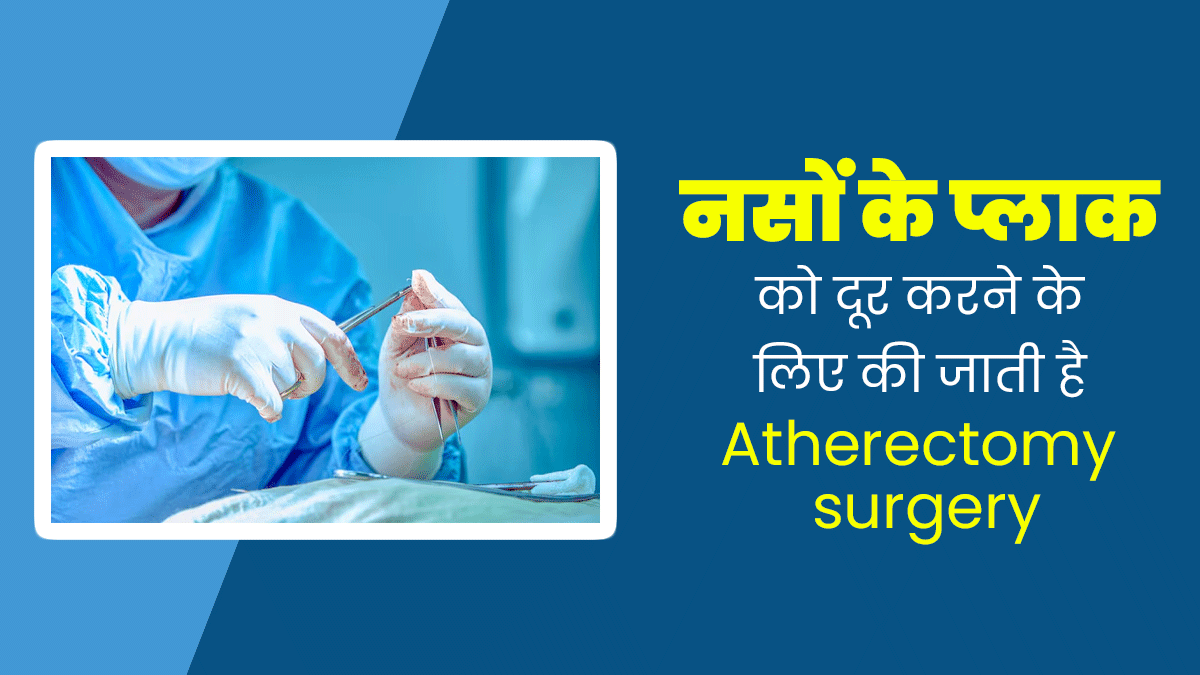नसों के प्लाक को दूर करने के लिए की जाती है Atherectomy surgery, जानें इसके फायदे