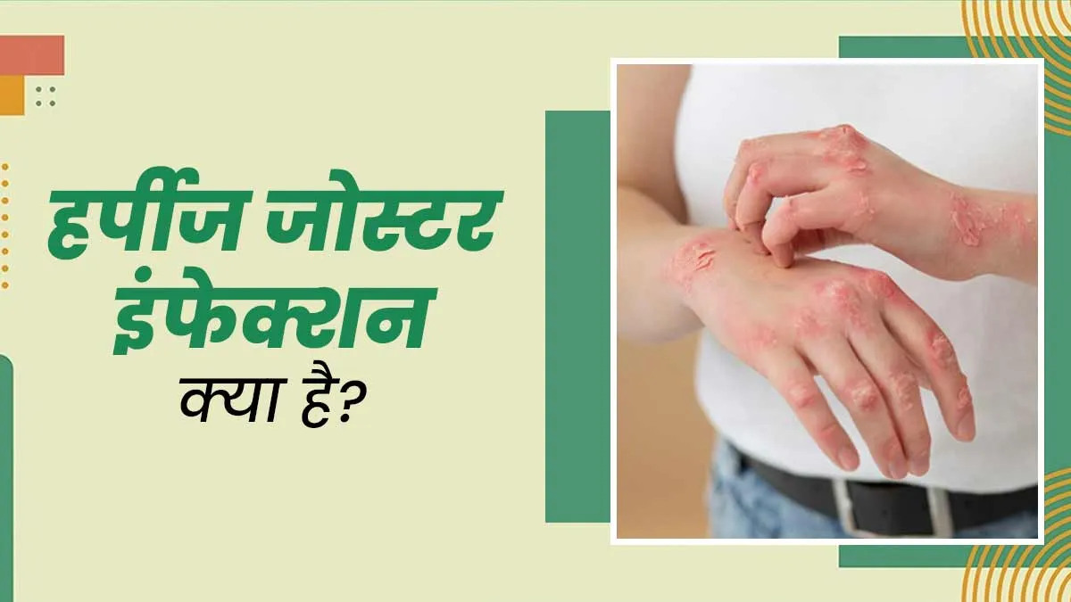 हर्पीज जोस्टर इंफेक्शन (स्किन से जुड़ी समस्या) क्या है? डॉक्टर से जानें