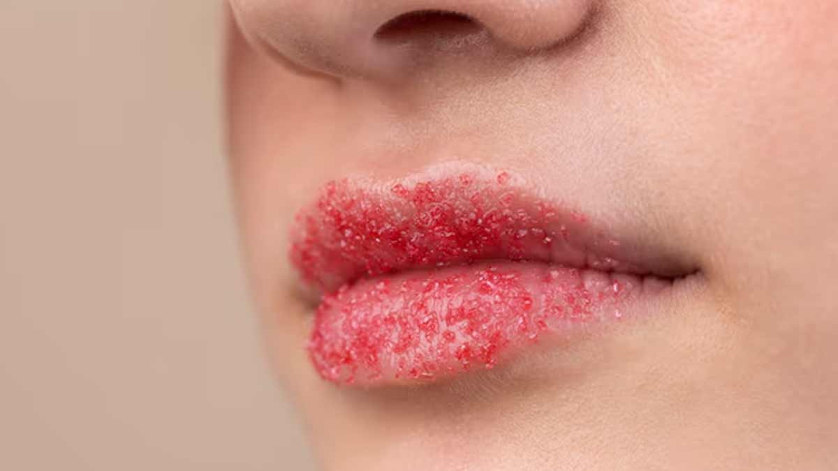 Chapped Lips remedies