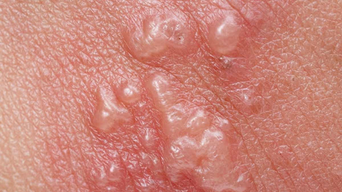 Herpes Zoster Infection