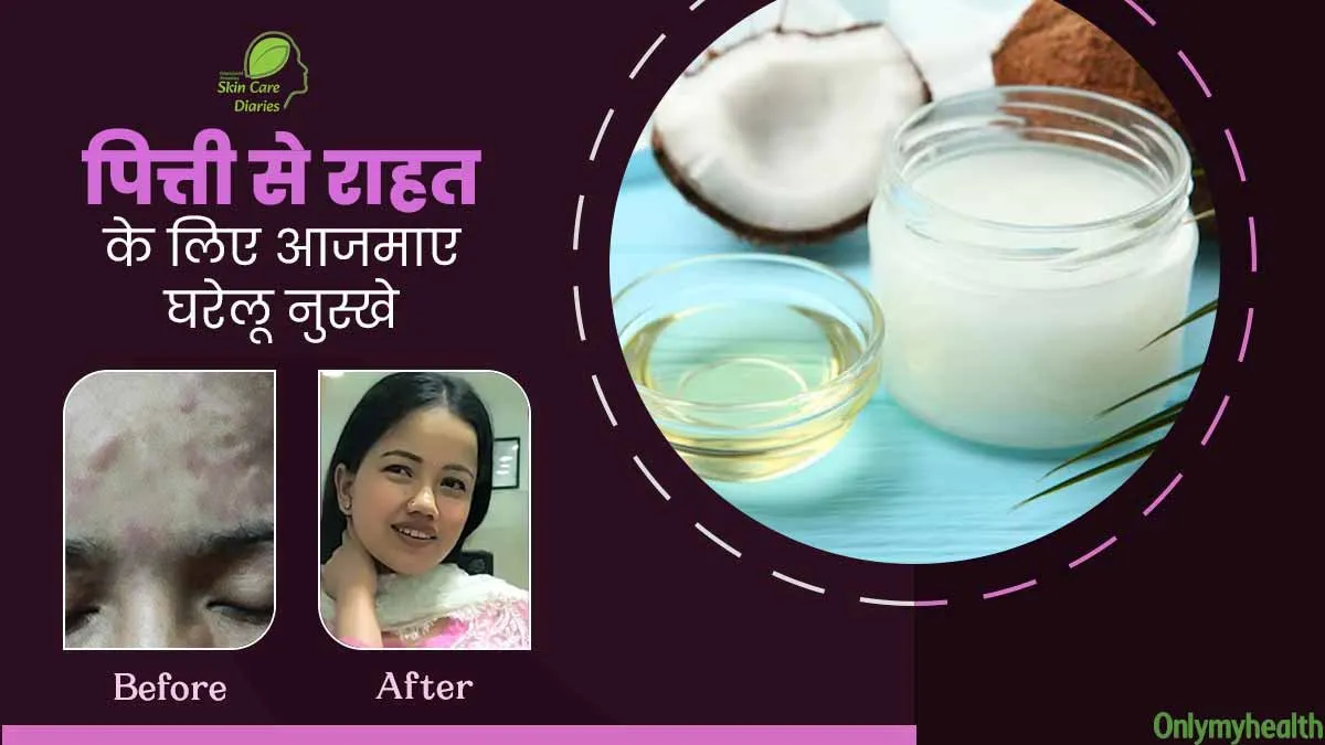 चेहरे पर पित्ती की समस्या से परेशान हो गई थीं अंजू, इन 2 घरेलू नुस्खों को आजमाने से मिली राहत