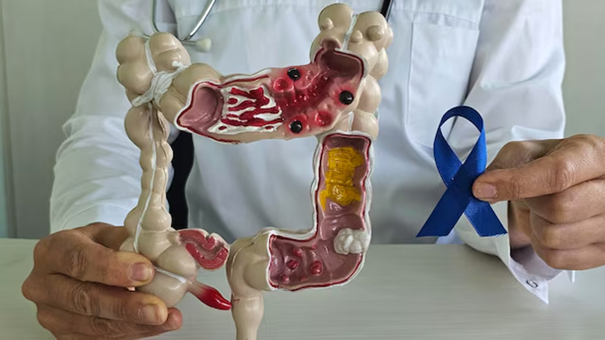 Colon cancer man vs. women expert advise