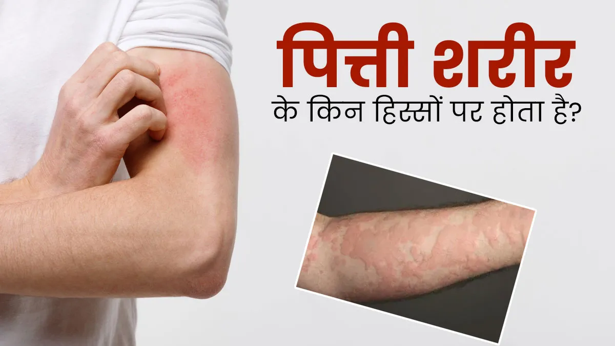 त्वचा के इन हिस्सों पर हो सकती है पित्ती की समस्या, डॉक्टर से जानें बचाव के उपाय
