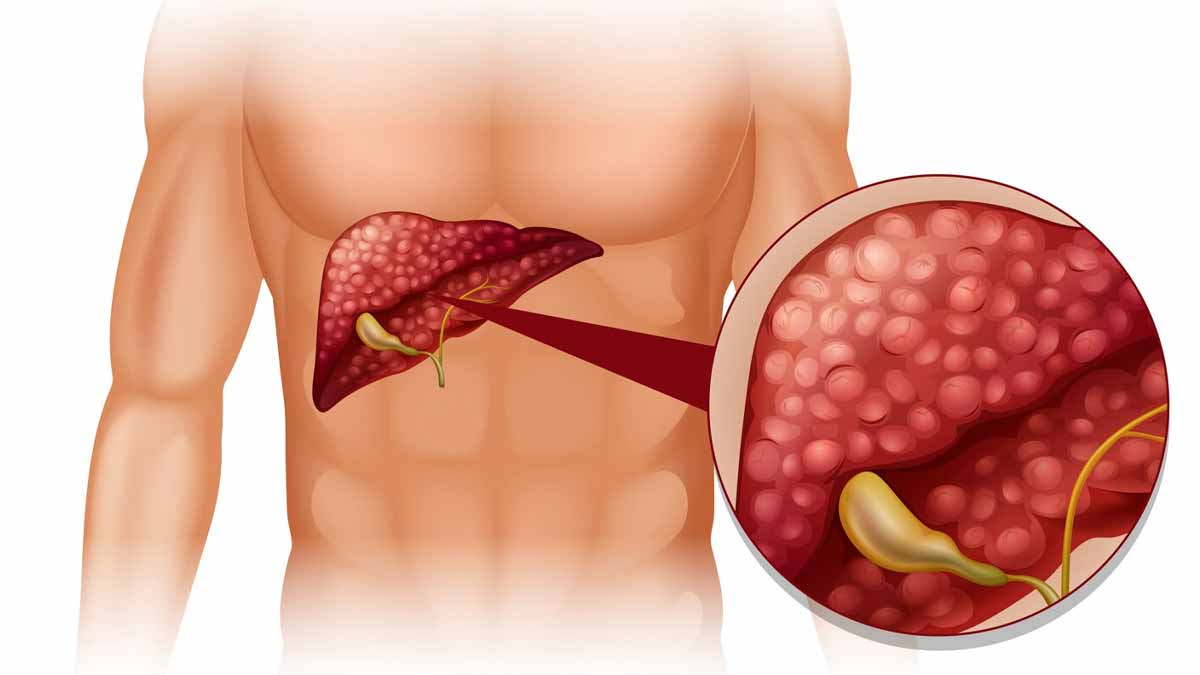 connection between vitamin e and fatty liver reversal 02