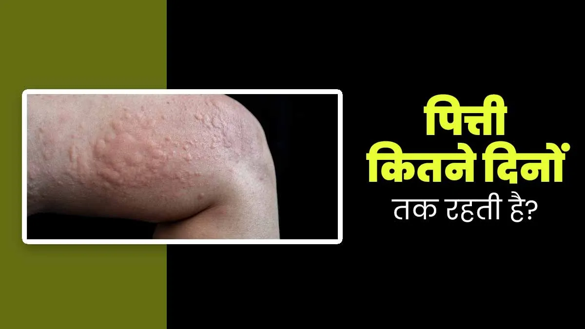 पित्ती कितने दिनों तक रहती है? डॉक्टर से जानें कब है चिंता करने की जरूरत
