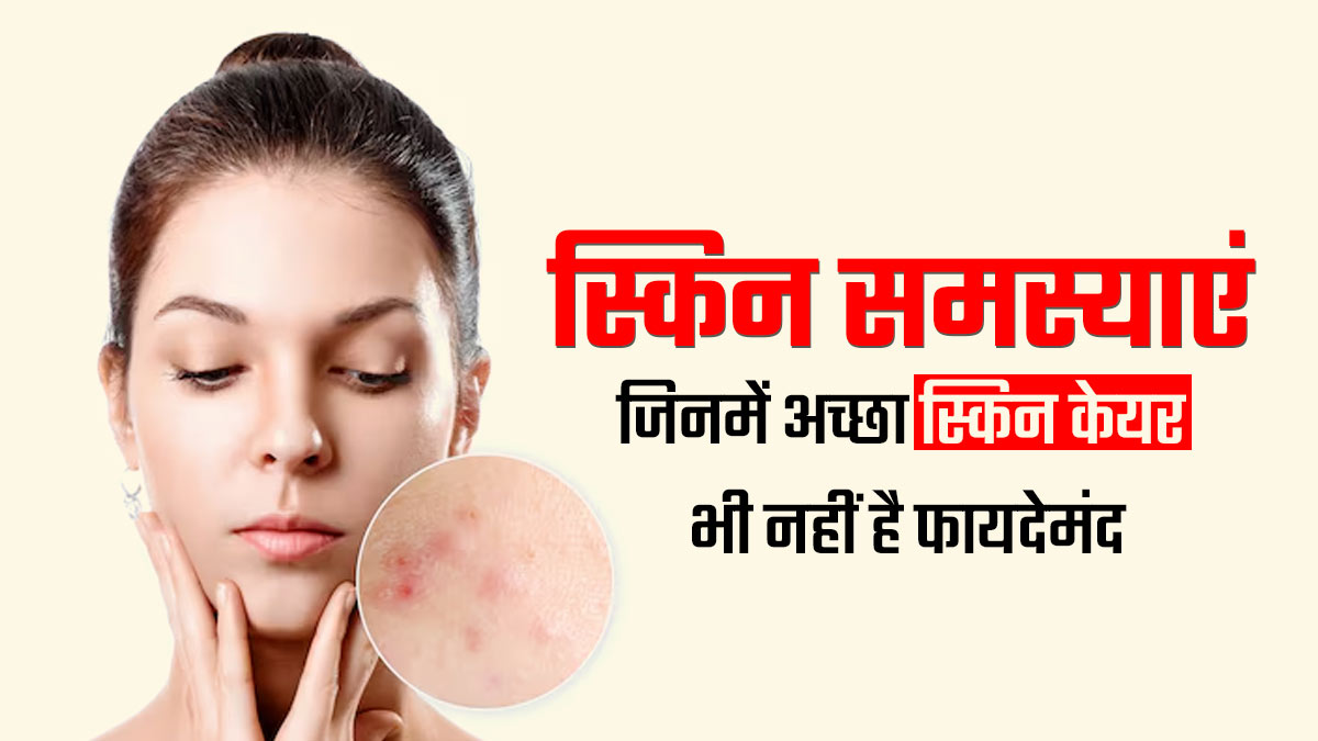 इन 5 त्वचा संबंधी समस्याओं में सही स्किन केयर रूटीन भी नहीं कर पाता काम, पड़ती है प्रॉपर इलाज की जरूरत