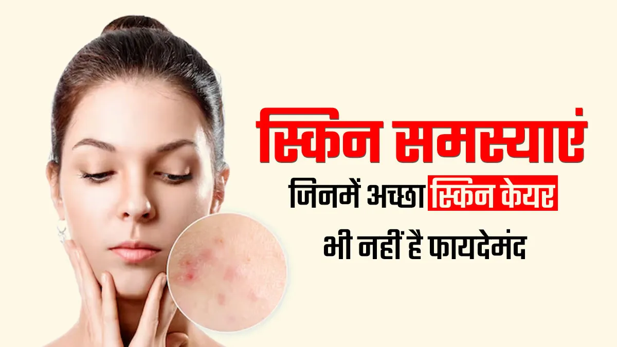 इन 5 त्वचा संबंधी समस्याओं में सही स्किन केयर रूटीन भी नहीं कर पाता काम, पड़ती है प्रॉपर इलाज की जरूरत