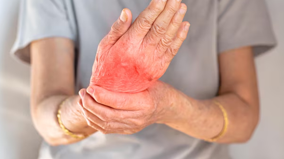 can-rheumatoid-arthritis-causes-sjogren-syndrome-i