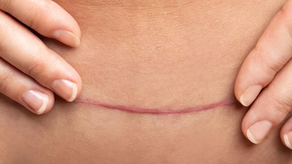 Correct Way To Sit After C-Section