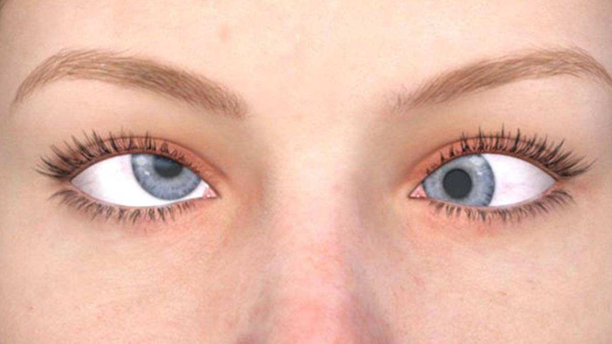 Types Of Amblyopia In Hindi common-types-of-amblyopia-in