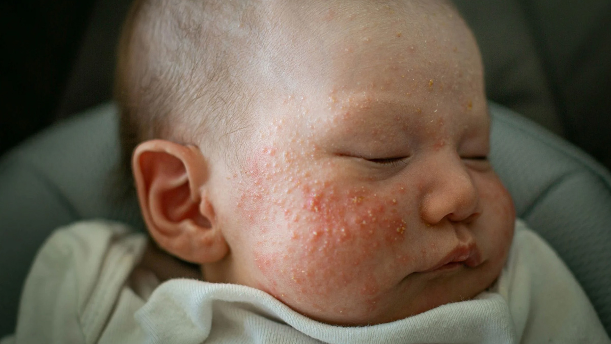 Neonatal-Acne-inside