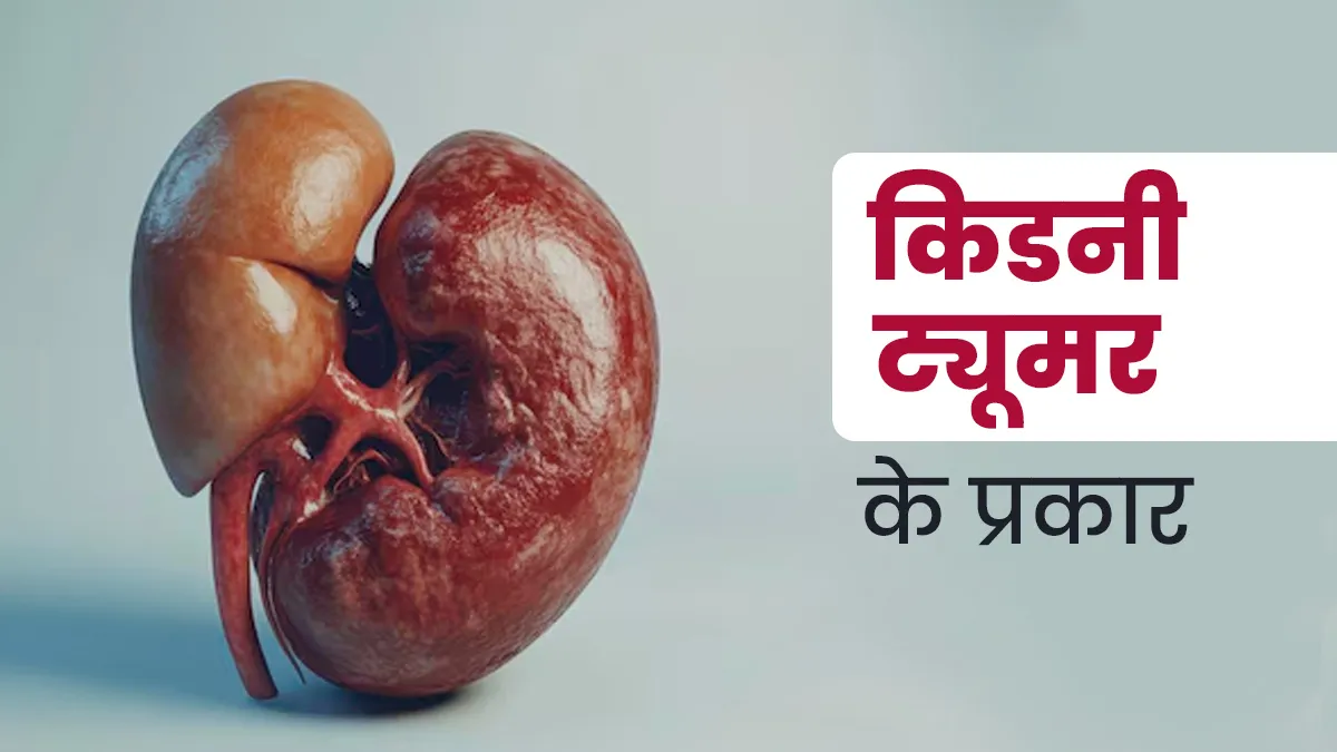 किडनी में ट्यूमर क‍ितने प्रकार के होते हैं? डॉक्‍टर से जानें