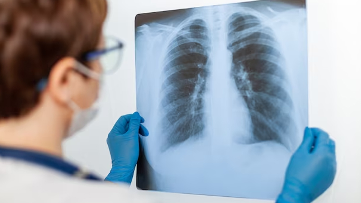 can tb cause pulmonary fibrosis  2