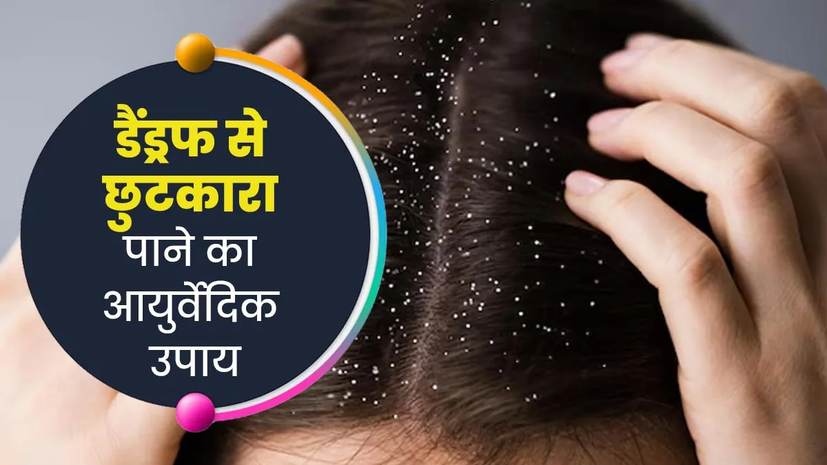सर्दियां आते ही दिखने लगता है डैंड्रफ, तो छुटकारा पाने के लिए अपनाएं ये आयुर्वेदिक उपाय