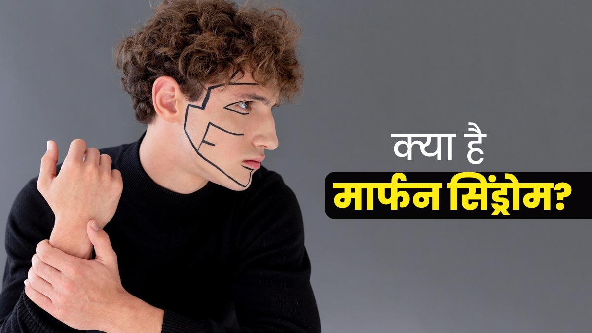 मार्फन स‍िंड्रोम से ब‍िगड़ता है हड्ड‍ी, आंख और हार्ट की सेहत, जानें इस दुर्लभ बीमारी के लक्षण, कारण और इलाज